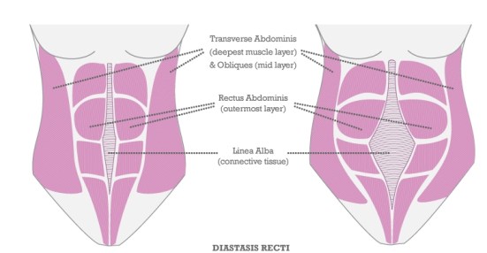 2012-10-17-DiastasisRectiV3